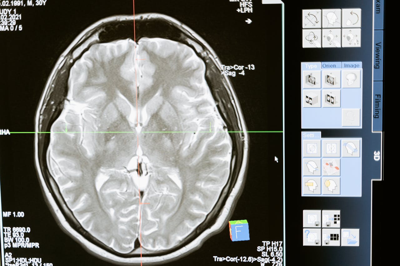 Mumio by mohlo pomôcť spomaliť progresiu Alzheimerovej choroby, ktorá postihuje mozog. Foto: Pexels.com