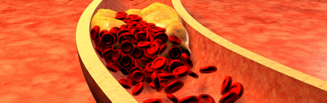 vysoky-cholesterol-mame-pre-vas-5-uzitocnych-tipov-ako-ho-znizit